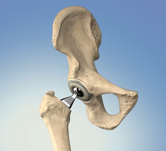 Revision Hip Replacement