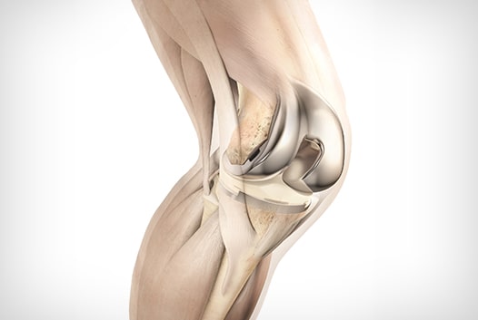 Knee Replacement Surgery