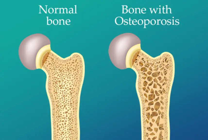 Osteoporosis