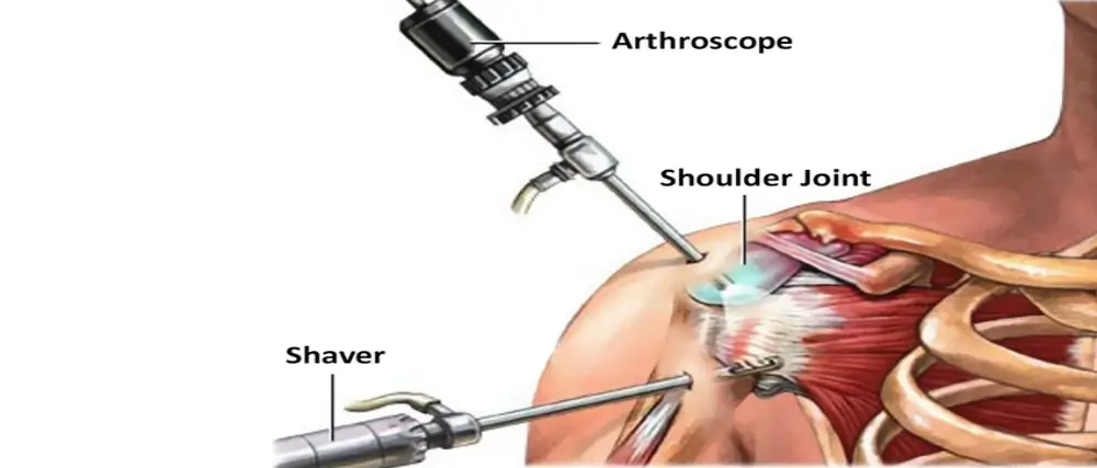 Arthroscopic Surgery